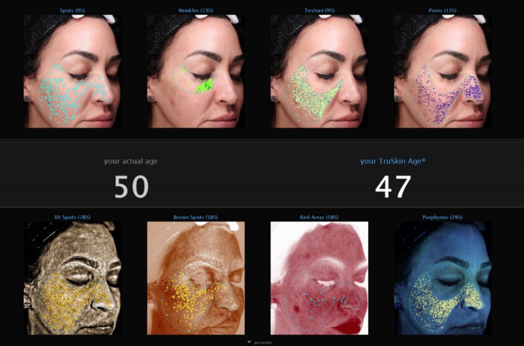 The Power of VISIA Skin Analysis - Aspire Med Spa