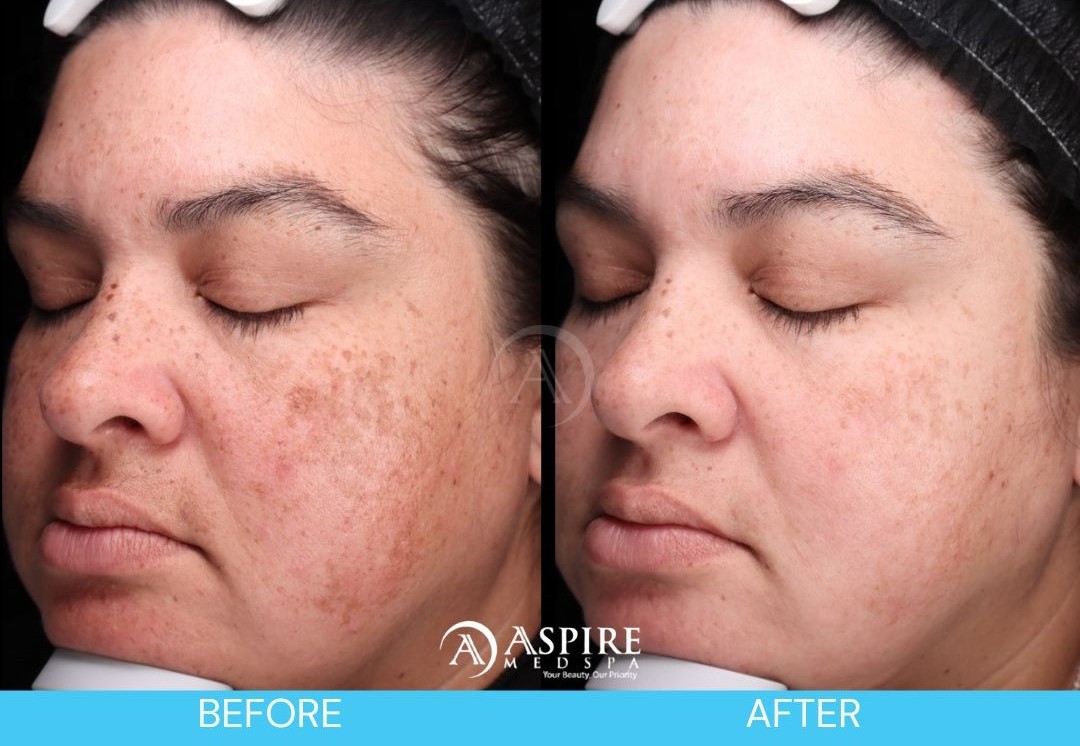 Before and After of Enlighten Peel