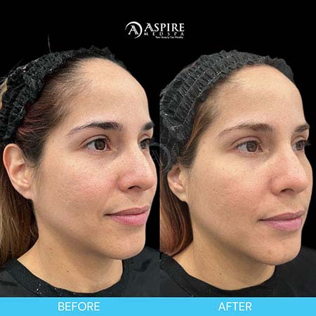 Before and After Images of Aspire MedSpa & Beauty Bar in Tampa, FL
