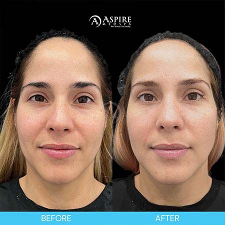 Before and After Images of Aspire MedSpa & Beauty Bar in Tampa, FL