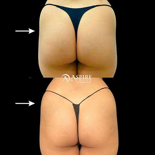 Post: Non-Surgical BBL: A Journey to Confidence and Curves in Tampa, FL