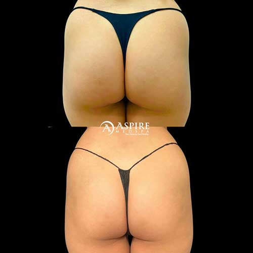 Post: Non-Surgical BBL: A Journey to Confidence and Curves in Tampa, FL