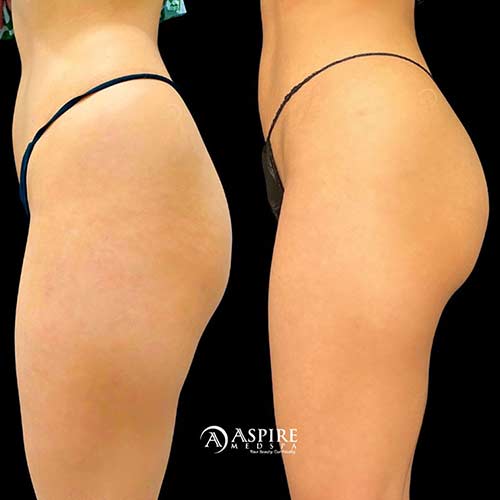 Post: Non-Surgical BBL: A Journey to Confidence and Curves in Tampa, FL