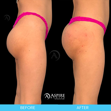 Before and After Images of Aspire MedSpa & Beauty Bar in Tampa, FL