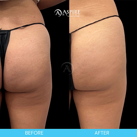 Before and After Images of Aspire MedSpa & Beauty Bar in Tampa, FL
