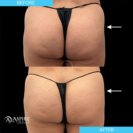 Before and After Images of Aspire MedSpa & Beauty Bar in Tampa, FL