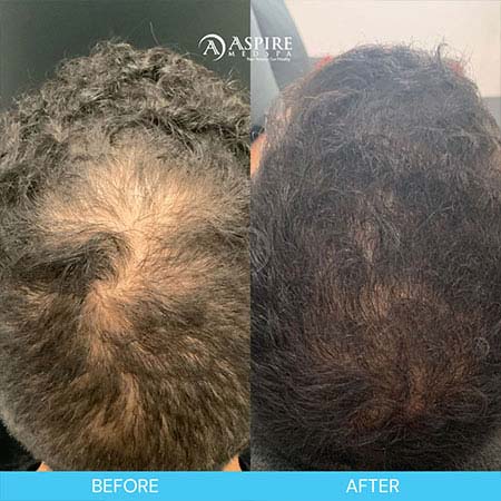 Before and After Images of Aspire MedSpa & Beauty Bar in Tampa, FL