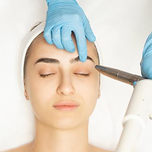 CoolPeel® Laser Treatment Near Me in Tampa, FL