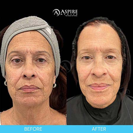 Before and After Images of Aspire MedSpa & Beauty Bar in Tampa, FL