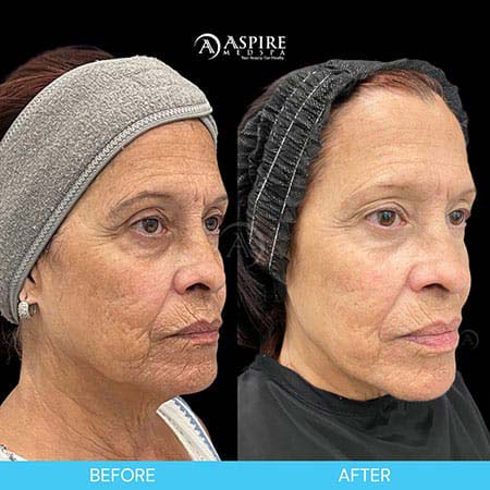 Before and After Images of Aspire MedSpa & Beauty Bar in Tampa, FL