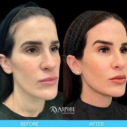 Post: Filler: The Transformation of Facial Balancing in Tampa, FL