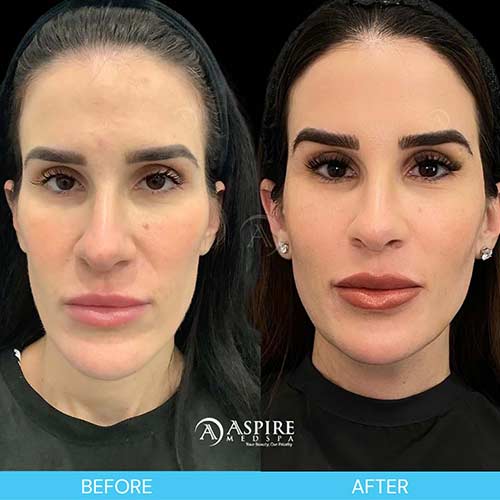 Post: Filler: The Transformation of Facial Balancing in Tampa, FL
