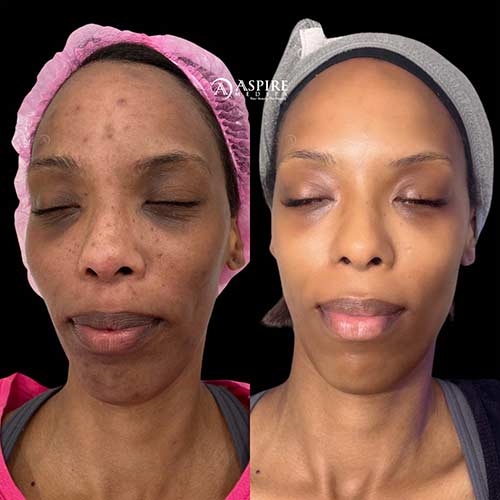 Post: HydraFacial for Acne Scars: A Real Transformation with Medical-Grade Skincare in Tampa, FL