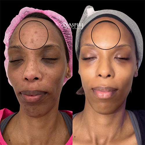 Post: HydraFacial for Acne Scars: A Real Transformation with Medical-Grade Skincare in Tampa, FL