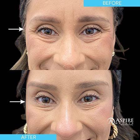 Before and After Images of Aspire MedSpa & Beauty Bar in Tampa, FL