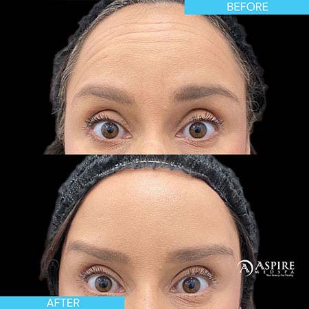 Before and After Images of Aspire MedSpa & Beauty Bar in Tampa, FL