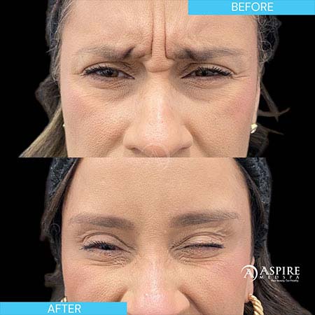 Before and After Images of Aspire MedSpa & Beauty Bar in Tampa, FL