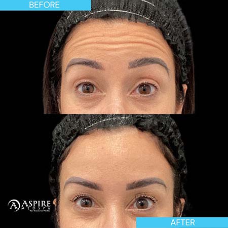 Before and After Images of Aspire MedSpa & Beauty Bar in Tampa, FL