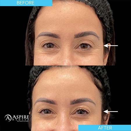 Before and After Images of Aspire MedSpa & Beauty Bar in Tampa, FL