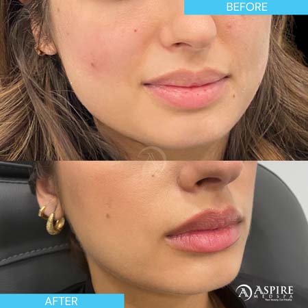 Before and After Images of Aspire MedSpa & Beauty Bar in Tampa, FL