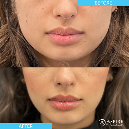 Before and After Images of Aspire MedSpa & Beauty Bar in Tampa, FL