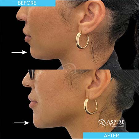 Before and After Images of Aspire MedSpa & Beauty Bar in Tampa, FL