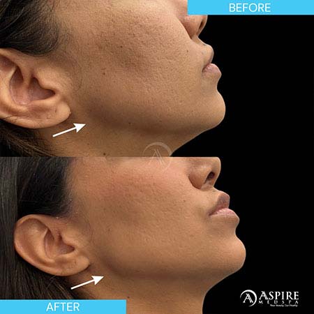Before and After Images of Aspire MedSpa & Beauty Bar in Tampa, FL