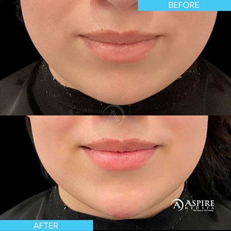 Before and After Images of Aspire MedSpa & Beauty Bar in Tampa, FL