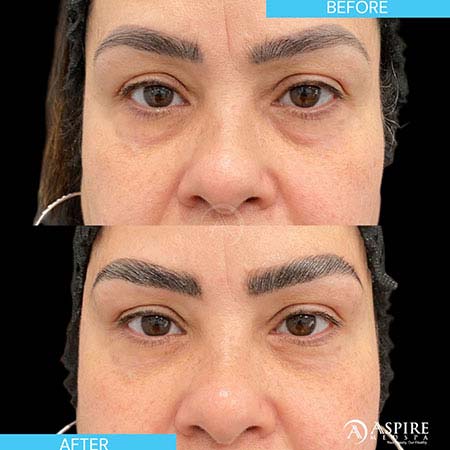 Before and After Images of Aspire MedSpa & Beauty Bar in Tampa, FL