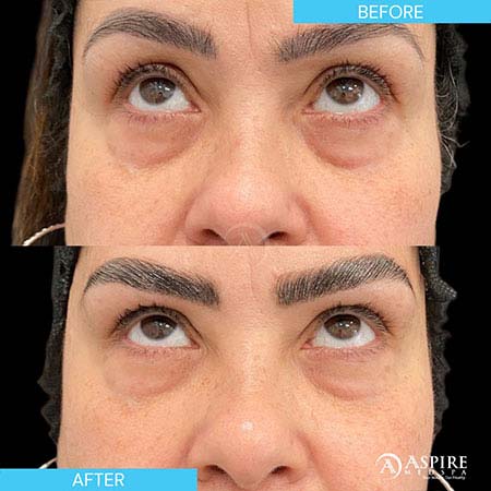 Before and After Images of Aspire MedSpa & Beauty Bar in Tampa, FL