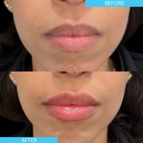 Before and After Images of Aspire MedSpa & Beauty Bar in Tampa, FL