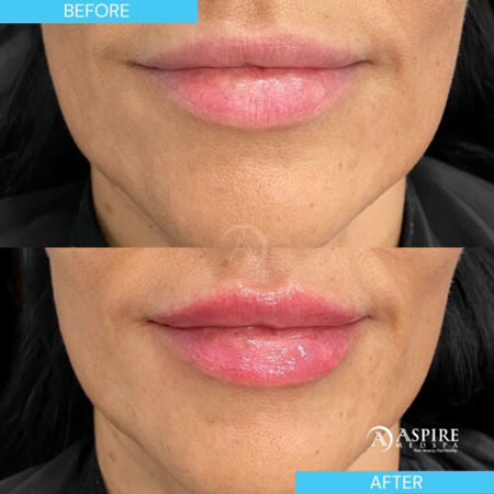 Before and After Images of Aspire MedSpa & Beauty Bar in Tampa, FL