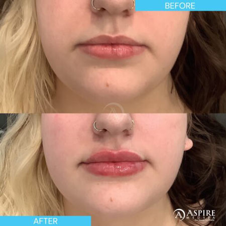 Before and After Images of Aspire MedSpa & Beauty Bar in Tampa, FL