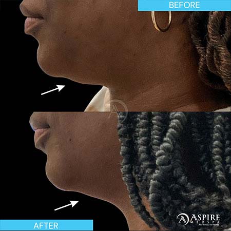Before and After Images of Aspire MedSpa & Beauty Bar in Tampa, FL