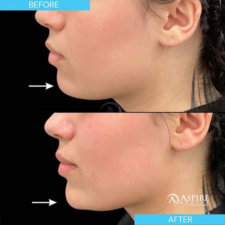 Before and After Images of Aspire MedSpa & Beauty Bar in Tampa, FL