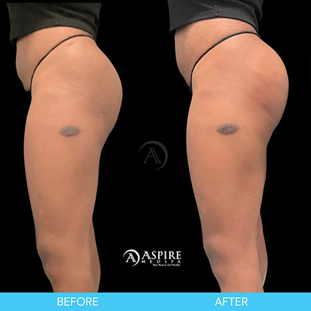 Non-Surgical BBL Specialist in Tampa, FL Non-Surgical BBL Specialist in Tampa, FL