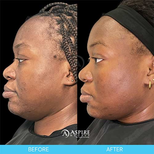 Post: Shed the Dead: Revitalize Your Skin with VI Peel This Season in Tampa, FL