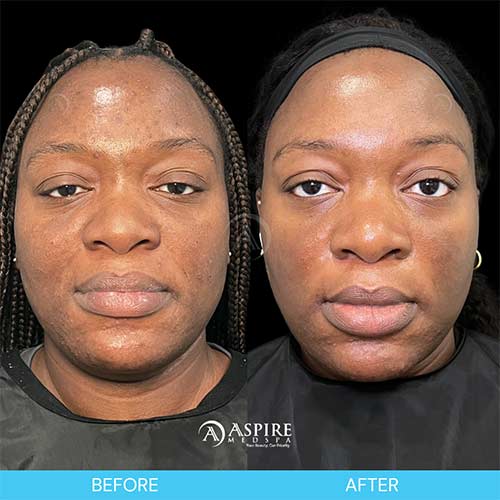 Post: Shed the Dead: Revitalize Your Skin with VI Peel This Season in Tampa, FL
