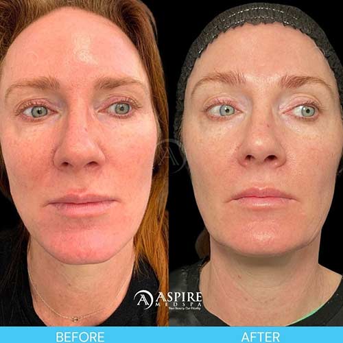 Post: Achieve Skincare Transformation with SkinBetter’s Mystro in Tampa, FL