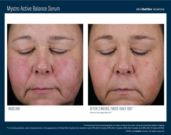 Post: April is Rosacea Awareness Month: Discover SkinBetter Science Mystro for Rosacea-Prone Skin in Tampa, FL