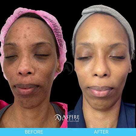 Before and After Images of Aspire MedSpa & Beauty Bar in Tampa, FL