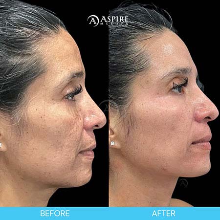 Before and After Images of Aspire MedSpa & Beauty Bar in Tampa, FL