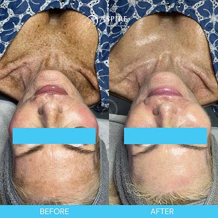 Before and After Images of Aspire MedSpa & Beauty Bar in Tampa, FL