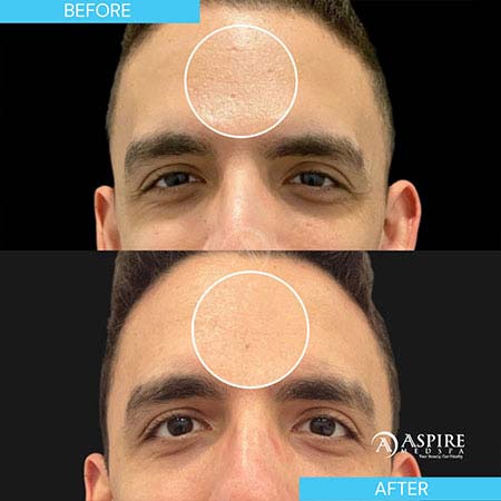 Before and After Images of Aspire MedSpa & Beauty Bar in Tampa, FL