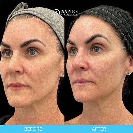 Before and After Images of Aspire MedSpa & Beauty Bar in Tampa, FL