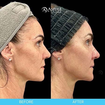Before and After Images of Aspire MedSpa & Beauty Bar in Tampa, FL