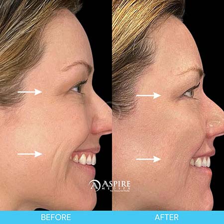 Before and After Images of Aspire MedSpa & Beauty Bar in Tampa, FL