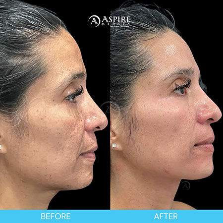 Before and After Images of Aspire MedSpa & Beauty Bar in Tampa, FL Before and After Images of Aspire MedSpa & Beauty Bar in Tampa, FL