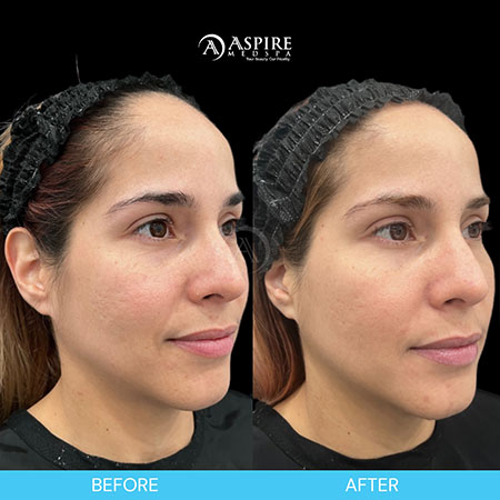Before and After Images of Aspire MedSpa & Beauty Bar in Tampa, FL Before and After Images of Aspire MedSpa & Beauty Bar in Tampa, FL