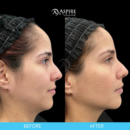 Before and After Images of Aspire MedSpa & Beauty Bar in Tampa, FL Before and After Images of Aspire MedSpa & Beauty Bar in Tampa, FL